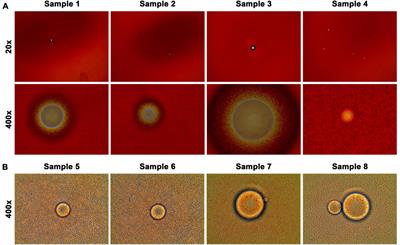 Circulating Fatty Objects and Their Preferential Presence in Pancreatic Cancer Patient Blood Samples